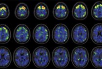 these images show areas of the brain where an experimental brain scan detected higher abnormal tau protein in a group of former NFL football players than compared to a group of control subjects. The former football players in the study have self-reported cognitive, mood, and behavior symptoms that are thought to be associated with CTE
