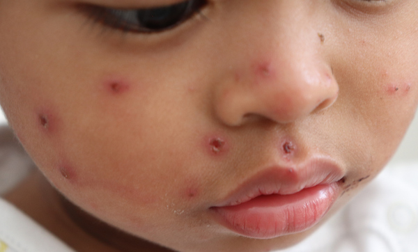 Closeup of a child's face with measles wounds