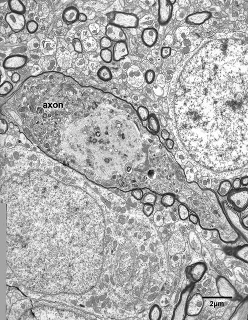 Chapter 4 Degenerating Axons Fine Structure Of The Aging Brain Boston University 8162