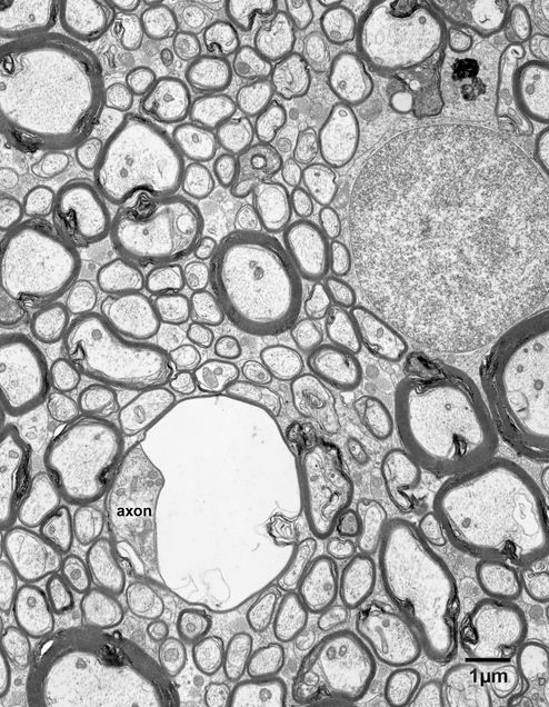 Chapter 7 – myelin balloons » Fine Structure of the Aging Brain ...