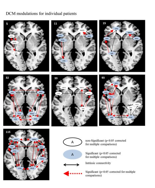 Figure 7. DCM connectivity map for patients for picture naming