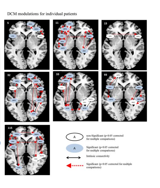Figure 8. DCM connectivity map for patients for semantic feature verification