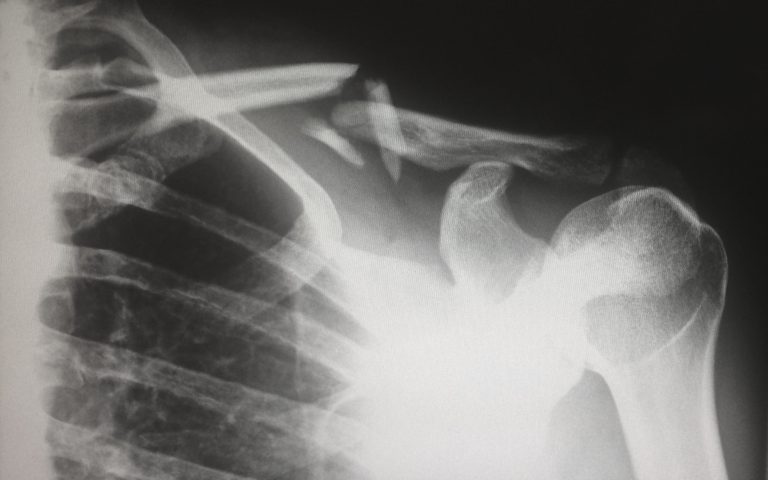 Fractured collar bone x-ray