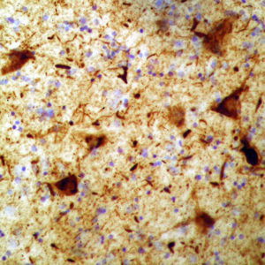 Microscopic section from John Grimsley showing numerous tau positive neurofibrillary tangles and neurites in the amygdala.