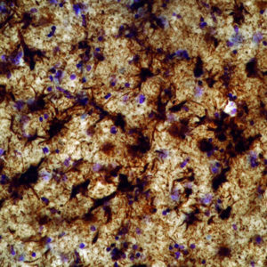 Microscopic section from a 73 year old world champion boxer with severe dementia showing very severe tau protein deposition in the amygdala and thalamus.
