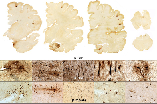 Ann McKee, School of Medicine, codirector Center for the Study of Encephalopathy CSTE