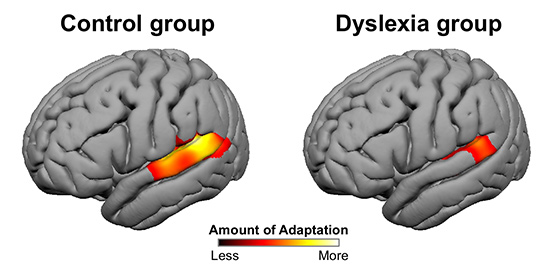 fMRI images show how people with dyslexia (right) and people without (left) adapt differently to a speaker’s voice