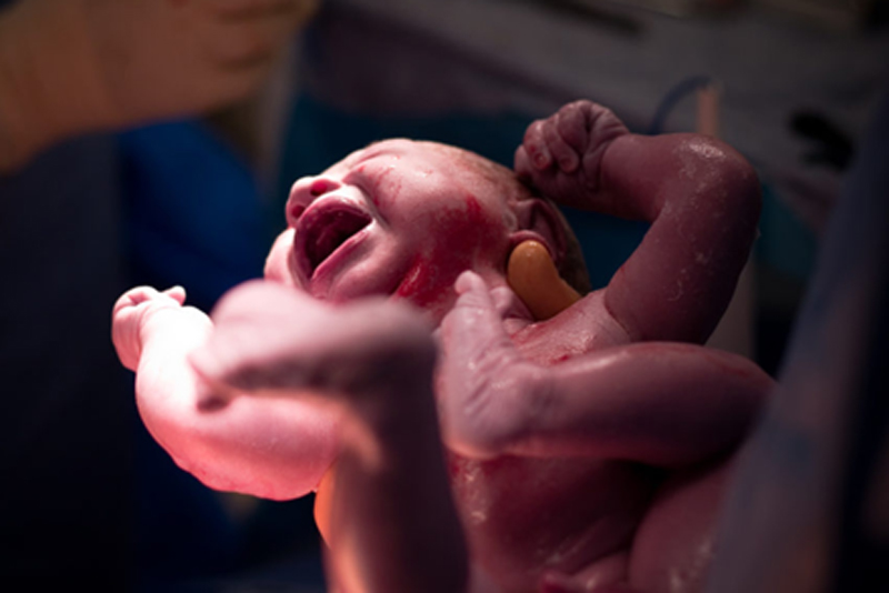 Why the C-section rate is much higher than it should be in US