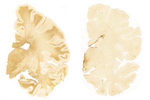 CTE in teenage brains