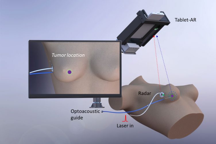 Illustration diagram showing how AcouStar works: A sensor patch on the skin picks up signals from an acoustic beacon implanted in the breast tumor and sends information on the tumor’s position to a tablet.