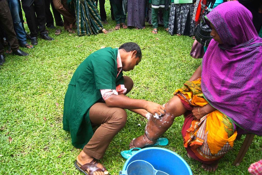 Lymphatic filariasis is preventable. When left unchecked, however, it can lead to painful—and permanent—hardening and swelling in the body, often in the legs.