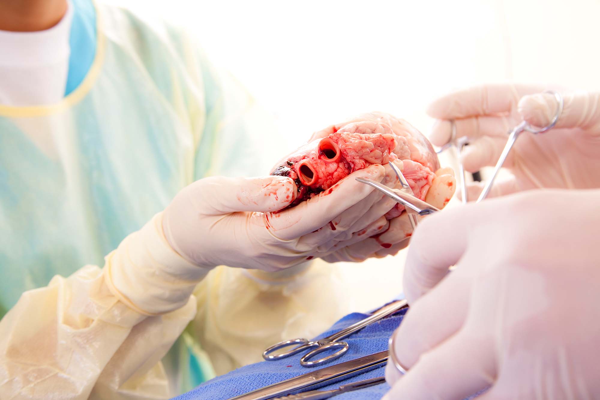 A surgical assistant holds a human heart in their hands during open heart surgery.