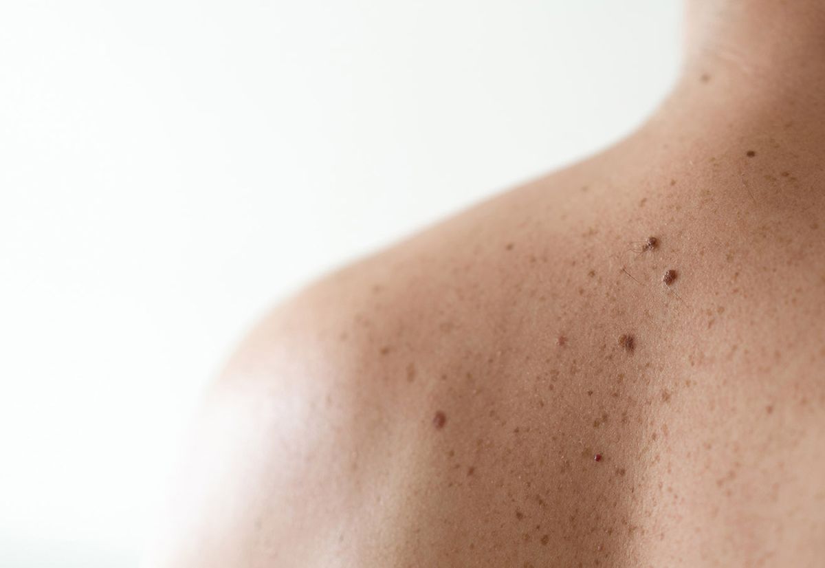 Photo: Photo of skin cancer on someone's back