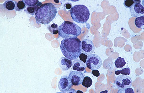  bone marrow smear, promyelocyte, neutrophil series, and eosinophilic myelocyte 