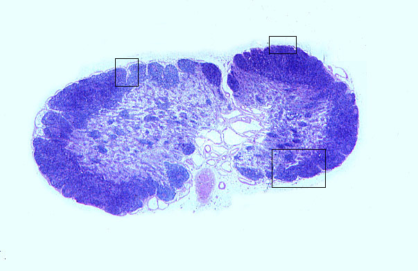  lymph node 