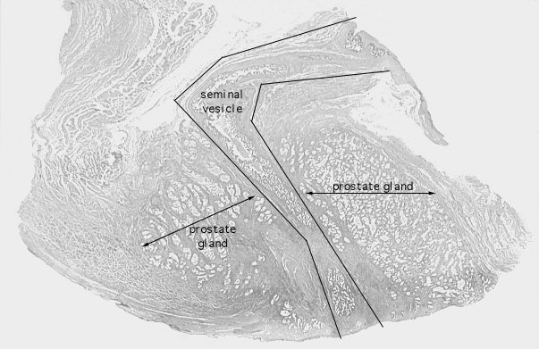  prostate, seminal vesicle 