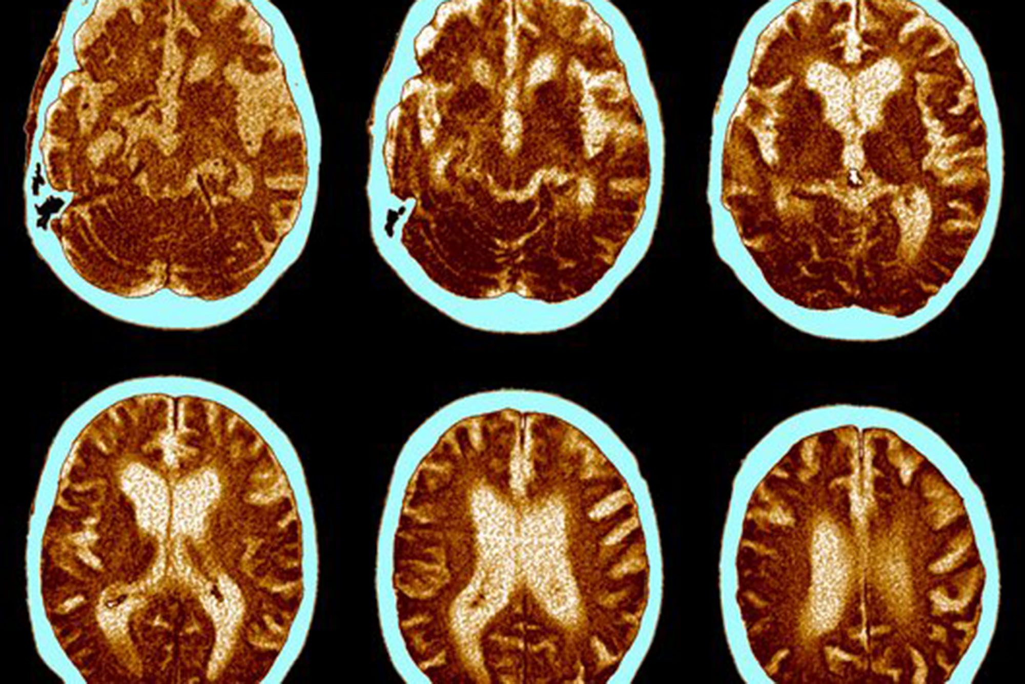 MRI images of the brain