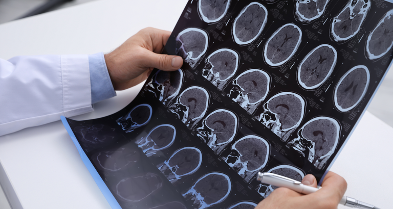 Doctor Examining MRI Images of Patient with Multiple Sclerosis a