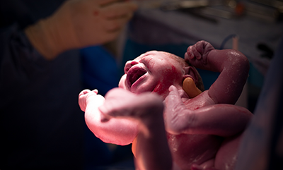 The Rate Of C-Sections Is Rising At An 'Alarming' Rate, Putting