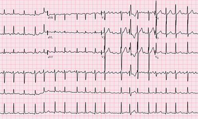 thumbnail-af-EKG