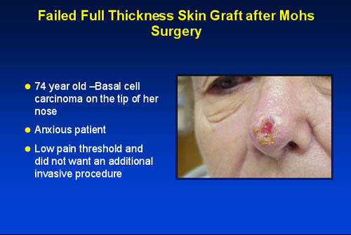 Failed full thickness skin graft after Mohs surgery