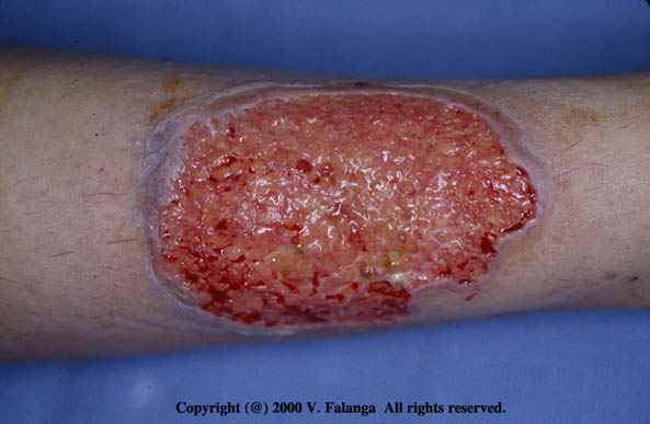 Pyoderma Gangrenosum Leg